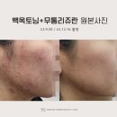 위례강변길 | 위례 리쥬란 : 시술 고민 중이라면 이것부터 확인하세요.
