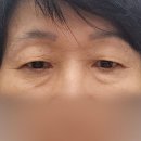 제이티성형외과 쌍커풀수술 이미지