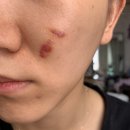 강남역 한의원 새살침 가격 내돈내산 10회차 후기