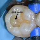 세라믹치과기공소 | [청주 레진치료] 인레이보다 레진이 좋은 이유