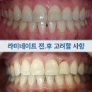 의정부제일치과의원 | 의정부치과의원- 라미네이트 전후 고려할 사항