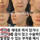 노블와이성형외과 안면거상재수술 방법 / 미니안면거상술 부작용 개선 사례 및 안면거상비용 정보 이미지