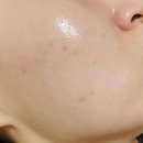 마곡 여드름 패인 흉터 치료 기간 TCA 도트필 인중 여드름 흉터 6회차 후기