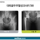 [대퇴골두무혈성괴사] 대퇴골두무혈성괴사 고관절수술 후 관리 이미지