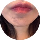 유케이메디칼 | 부산해운대턱필러 잘하는 곳 턱필러 + 자갈턱 보톡스 후기