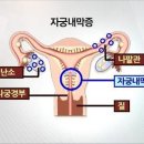 자궁내막증, 심한 생리통. 골반통. 요통 이미지