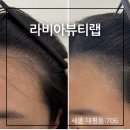(세종 헤어라인 문신) SMP문신으로 얼굴축소 라비아뷰티랩