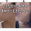 압구정로데오피부과 턱라인관리하고 효과본 튠페이스후기