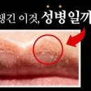 단순포진 입술 헤르페스 바이러스 감염 이미지