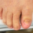 문제성발톱 분당발톱무좀 케어받고 있는 오로지푸스앤네일