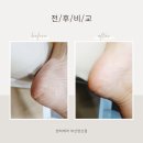 엔피케어 - 중구 종가6길 4-5 | 부산발관리 받고 자신감 되찾은 여름 연산동발각질 엔피케어 부산연산점 후기