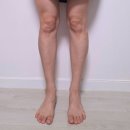 하얀멍이 | 청담 피부과) 종아리 보톡스 효과, 통증, 부작용 후기