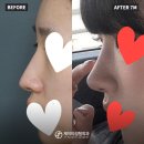 JT빌딩 | 💜[코재수술 전후 셀카] 자가늑연골 코재 전후 후기