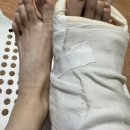 천보파트너스 | [흑석 중앙대병원] 발 주상골 , 종골 골절 수술후 2주차,
