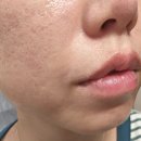 스피츠 | 팔자주름 피부탄력 관리에 좋은 니들패치, 최강상사스토어 케어비스 스피츠 스킨 리프트 패치 후기