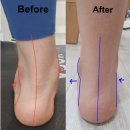 사파동269 | 사파동필라테스 발아치 높이가 중요한 이유 발바닥에 통증이 느껴진다면 필독