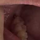 턱편한사랑니치과의원 | 쭐쭐 눈물 흘린 썰 푼다.. / 매복사랑니 발치🦷 / 4호선 범계역 사랑니발치전문병원 턱편한사랑니치과의원