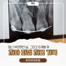 우리교정치과기공소 | 아이 앞니 부러짐, 호매실 치과에서 치아 파절 치료 후기 - 골절 진단비/깁스/교정 총 정리