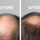 클라스코인 | 5%클라스코테론(Clascoterone) 임상 3상 통과, 탈모인에게 게임체인저가 될까?