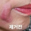 엘레나 광주본점 | 광주 슈퍼젝션, 피부과 시술의 부작용자를 위한 관리