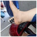 비고르바른건강+고주파 | 비고르바른건강 고주파