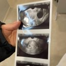 라움메디 | 평택 라움산부인과 첫 방문 후기(feat. 초음파 사진)