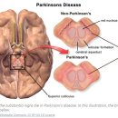 파킨슨병 초기증상과 치료방법 이미지