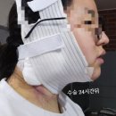 (주)지피코 1공장 | [올하트 성형외과] 이중턱 근육묶기 솔직후기. 내 턱 광명찾기 프로젝트