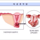 자궁 경부암 이미지