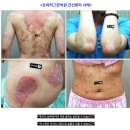고통스러운 아토피, 피부 건선과 각종 피부병의 원인과 치료 이미지