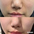 땀박골 | 청담피부과 쥬브아셀 8 전후 비교 후기