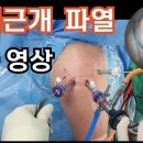내 어깨가 시큰 거리는 회전근개파열 수술 이미지