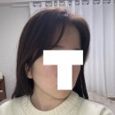 탄력 리프팅, 모공축소 튠페이스 포텐자 스킨보톡스 후기 :광화문 헤리티크