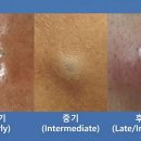 [봉담 성모피부과] 짜도 짜도 자꾸 생기는 피부 혹, '표피낭종' &amp; '피지낭종' 원인부터 흉터 없는 치료...