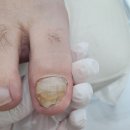 울산 발톱무좀 관리, 하이푸스 울산수암점 방문 후기
