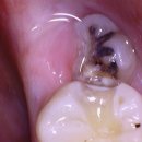 리볼리치과의원 | 리볼리치과의원 사랑니 발치 후기 – 사진으로 보여주니 안심! 아프지 않고 깔끔하게