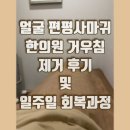 바름한의원 | [내돈내산] 얼굴 편평사마귀 제거 일주일 회복 과정_일산 한의원 거우침 치료 후기