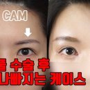 쌍꺼풀수술했는데 오히려 인상이 강해졌다면？ 이마거상이 필요한 케이스는？ 이미지