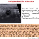 Periappendiceal fat infiltration 이미지