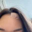 박종태 | 피지낭종 제거후기, 실비 가능 :: 박종태 유바외과