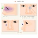 광주대로 45 | 안면골절 수술 후 코 재수술, 기능과 미용을 모두 만족시키는 방법은?