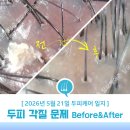 생약초 | 두피 각질과 비듬이 많은 이유와 좋아게 만든 후기