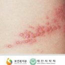 조에피부과 네이버블로그