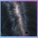 편백한의원 | 지루성두피염 한의원 안가고도 한방샴푸로 해결