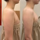 캐나다 신부님 2월 예식 시그니쳐케어 찐후기🫰🏻 강동천호웨딩관리 승모근 라운드숄더 드레스투어