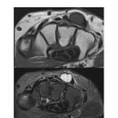 Re: intratendinous Ganlion Cyst 이미지