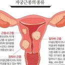 자궁 근종(물혹) 및 원인과 검사 예방 크기 통증 폐경기 임신 이미지