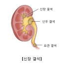 신장 결석 Renal stone 이미지