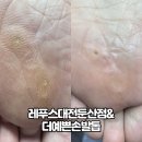 레푸스대전둔산점&더예쁜손발톱 | 대전내성발톱 티눈제거 고민 끝! 레푸스대전둔산점 & 더예쁜손발톱 후기