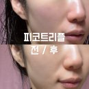 피코트리플 피코토닝 제네시스토닝 홍조 브이빔레이저 후기 압구정피부과 추천